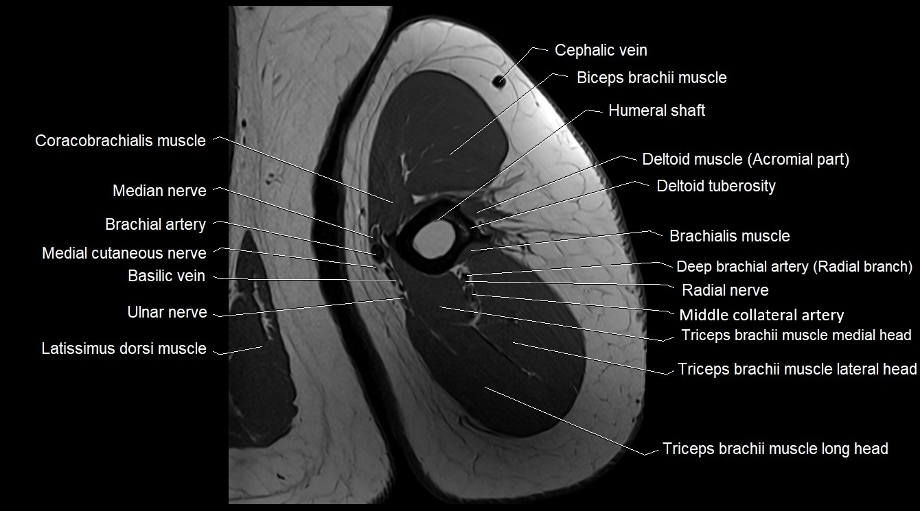 Upper arm( humerus) cross section anatomy MRI 3T axial image 30.webp